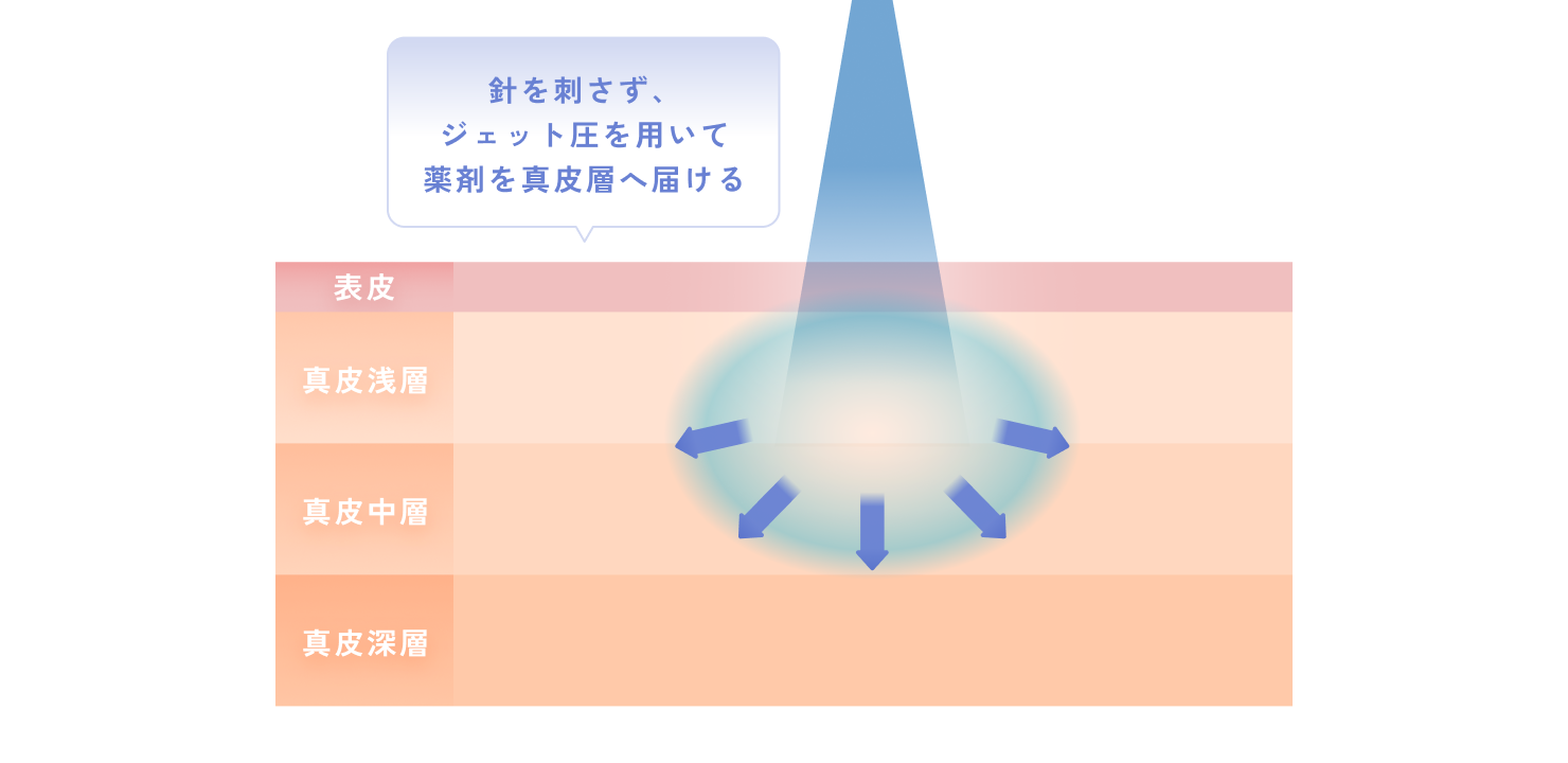 針を刺さず、ジェット圧を用いて薬剤を真皮層へ届ける