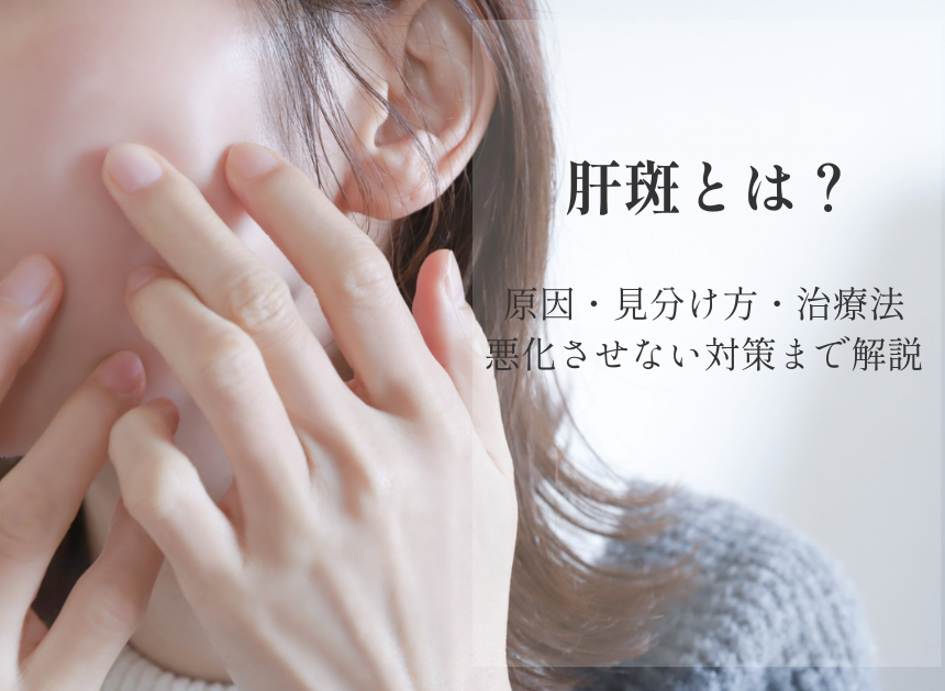 肝斑とは？原因・見分け方・治療法｜悪化させない対策まで解説